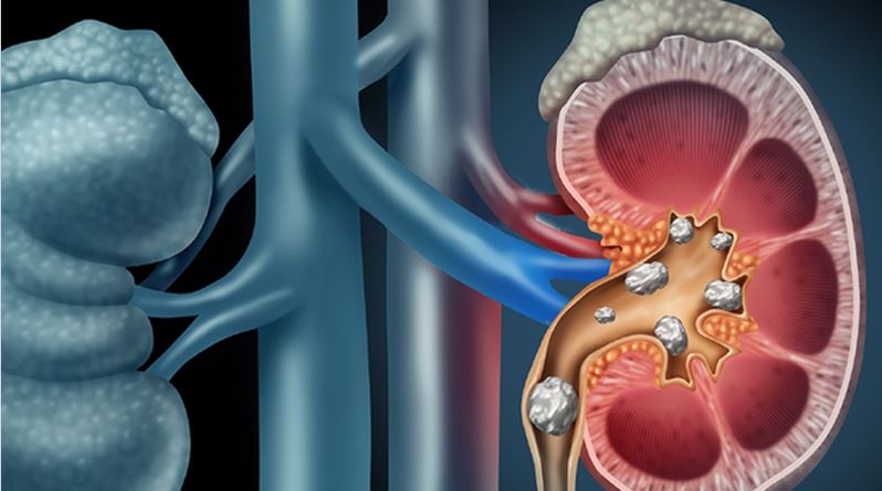 Uống ít nước tăng nguy cơ mắc bệnh sỏi thận